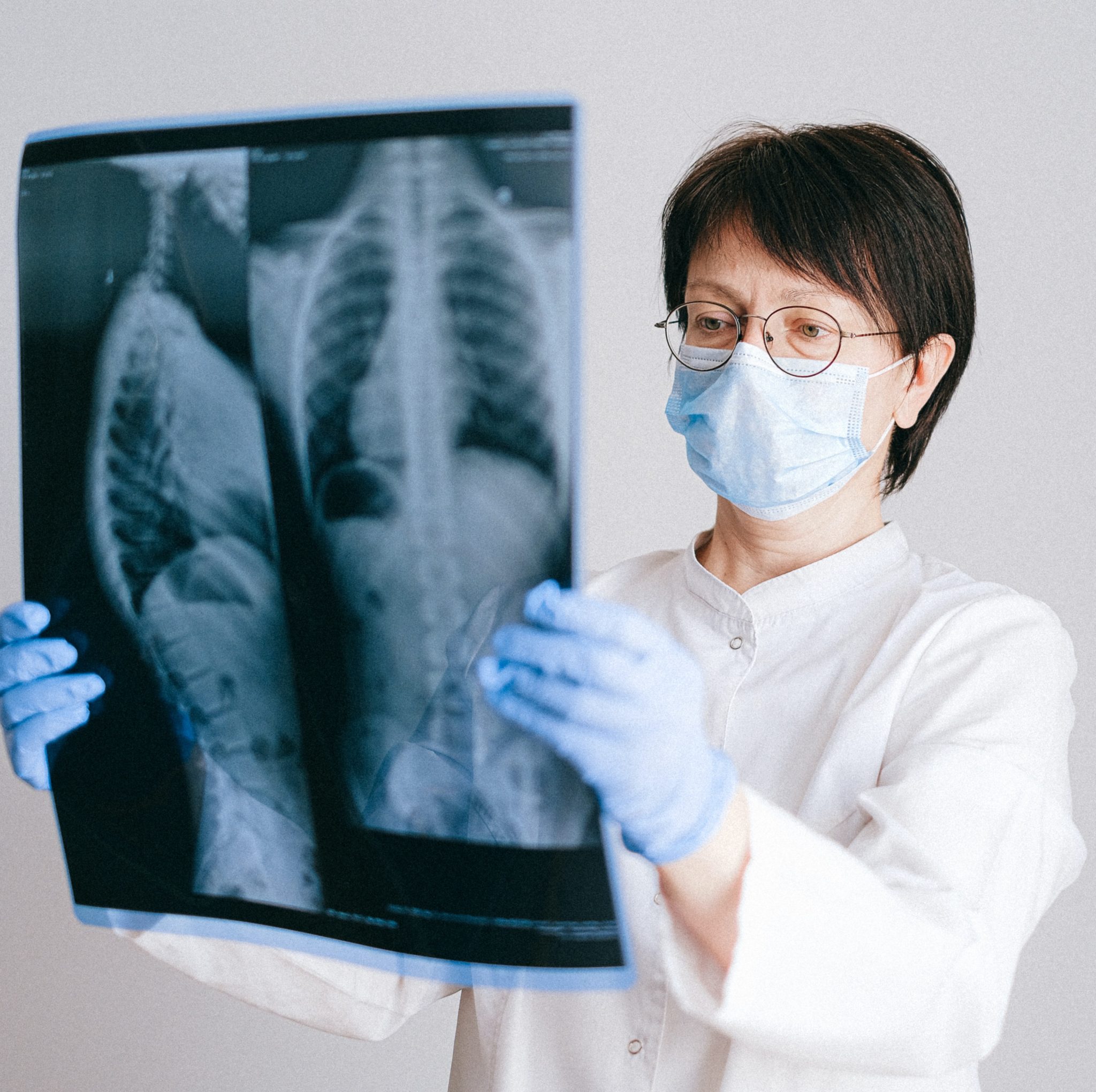 Gravedad en pacientes con fibrosis pulmonar idiopática es muy alta si se contagian de Covid-19